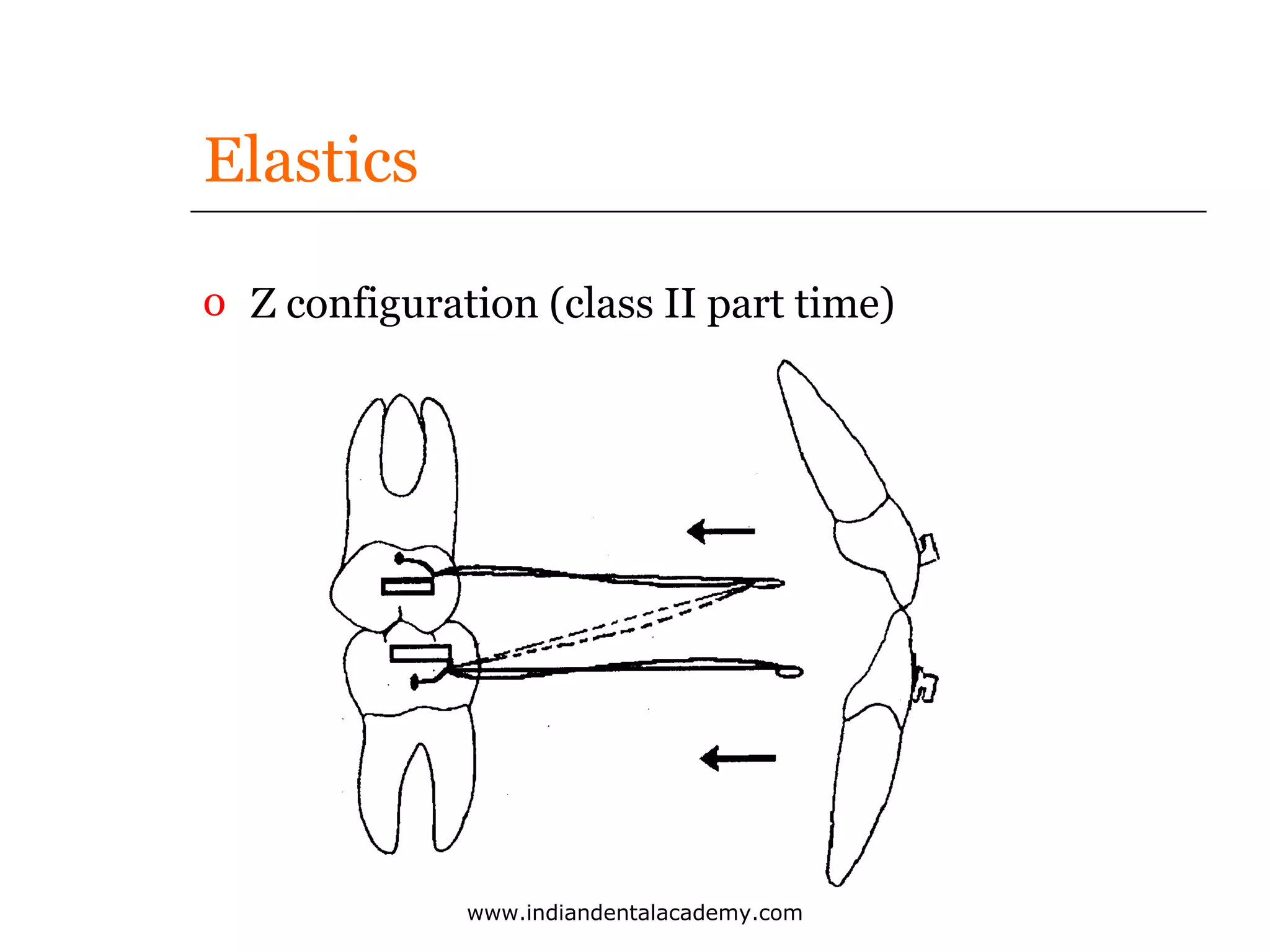 Elastics
o Z configuration (class II part time)

www.indiandentalacademy.com

 