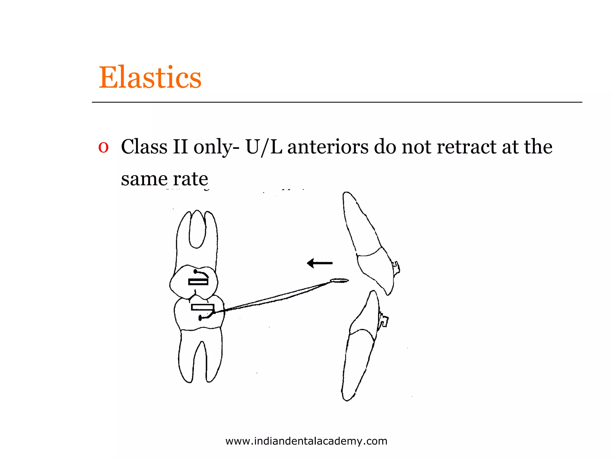 Elastics
o Class II only- U/L anteriors do not retract at the
same rate

www.indiandentalacademy.com

 
