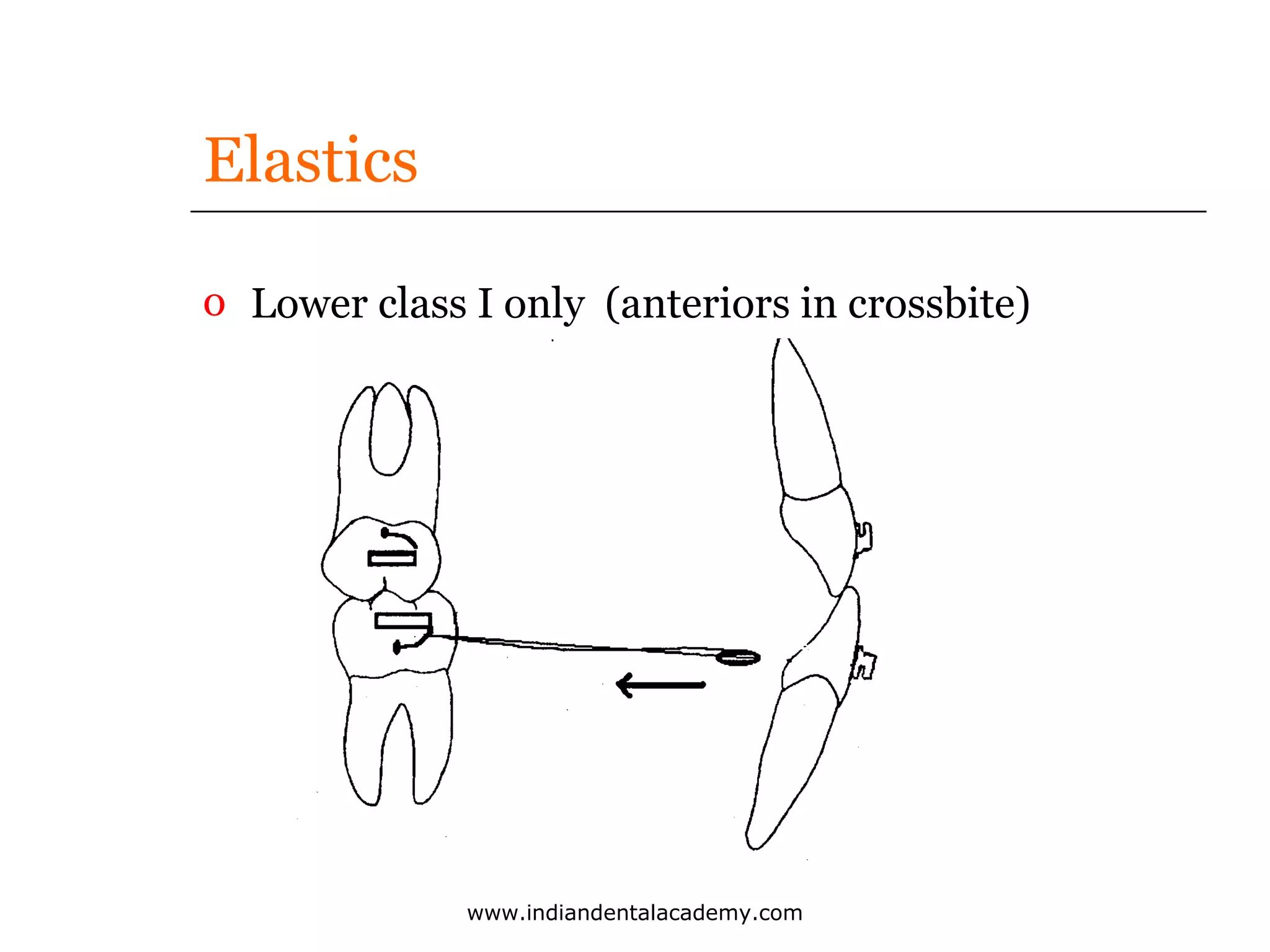 Elastics
o Lower class I only (anteriors in crossbite)

www.indiandentalacademy.com

 