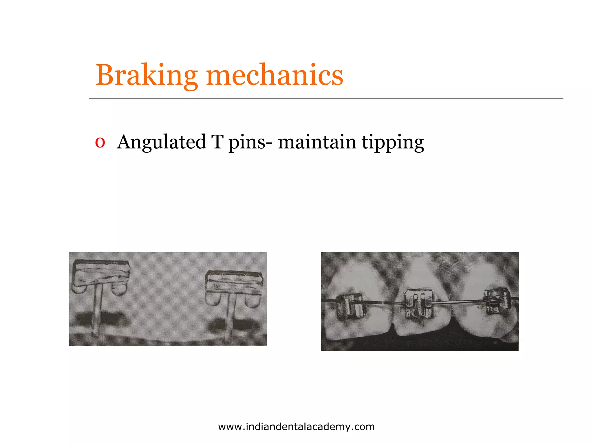 Braking mechanics
o Angulated T pins- maintain tipping

www.indiandentalacademy.com

 