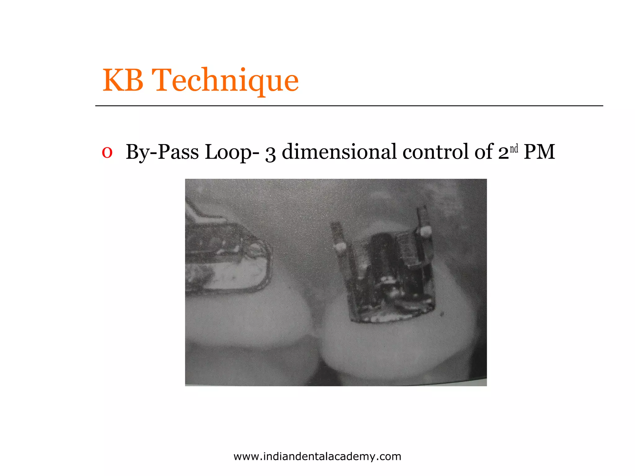 KB Technique
o By-Pass Loop- 3 dimensional control of 2nd PM

www.indiandentalacademy.com

 