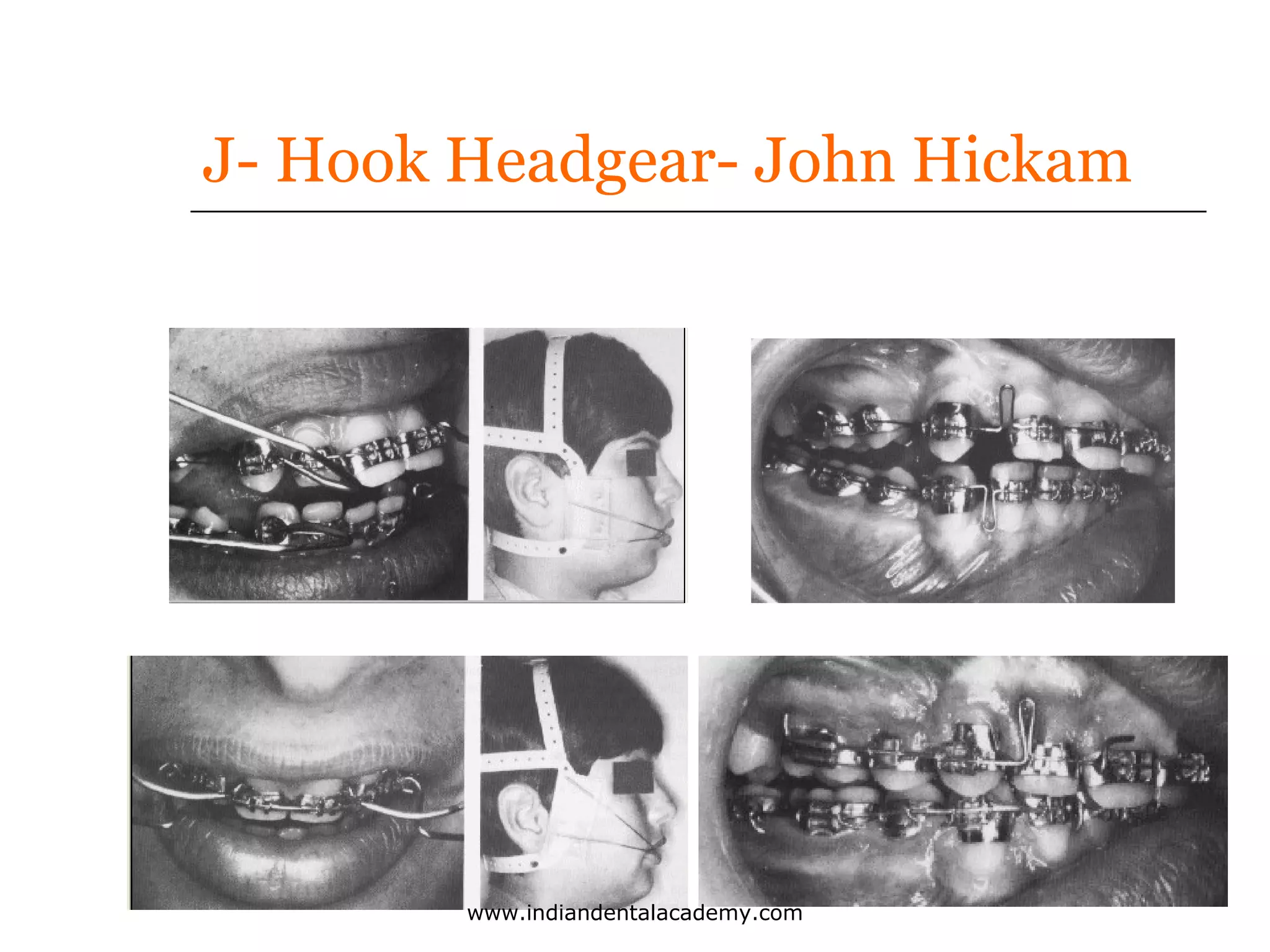 J- Hook Headgear- John Hickam

www.indiandentalacademy.com

 