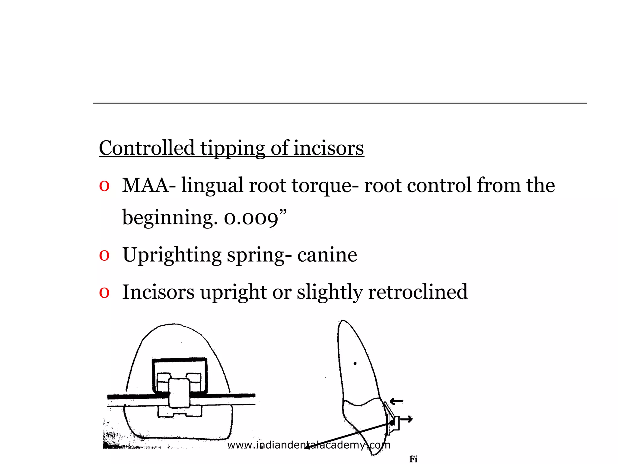 Controlled tipping of incisors
o MAA- lingual root torque- root control from the
beginning. 0.009”
o Uprighting spring- canine
o Incisors upright or slightly retroclined

www.indiandentalacademy.com

 