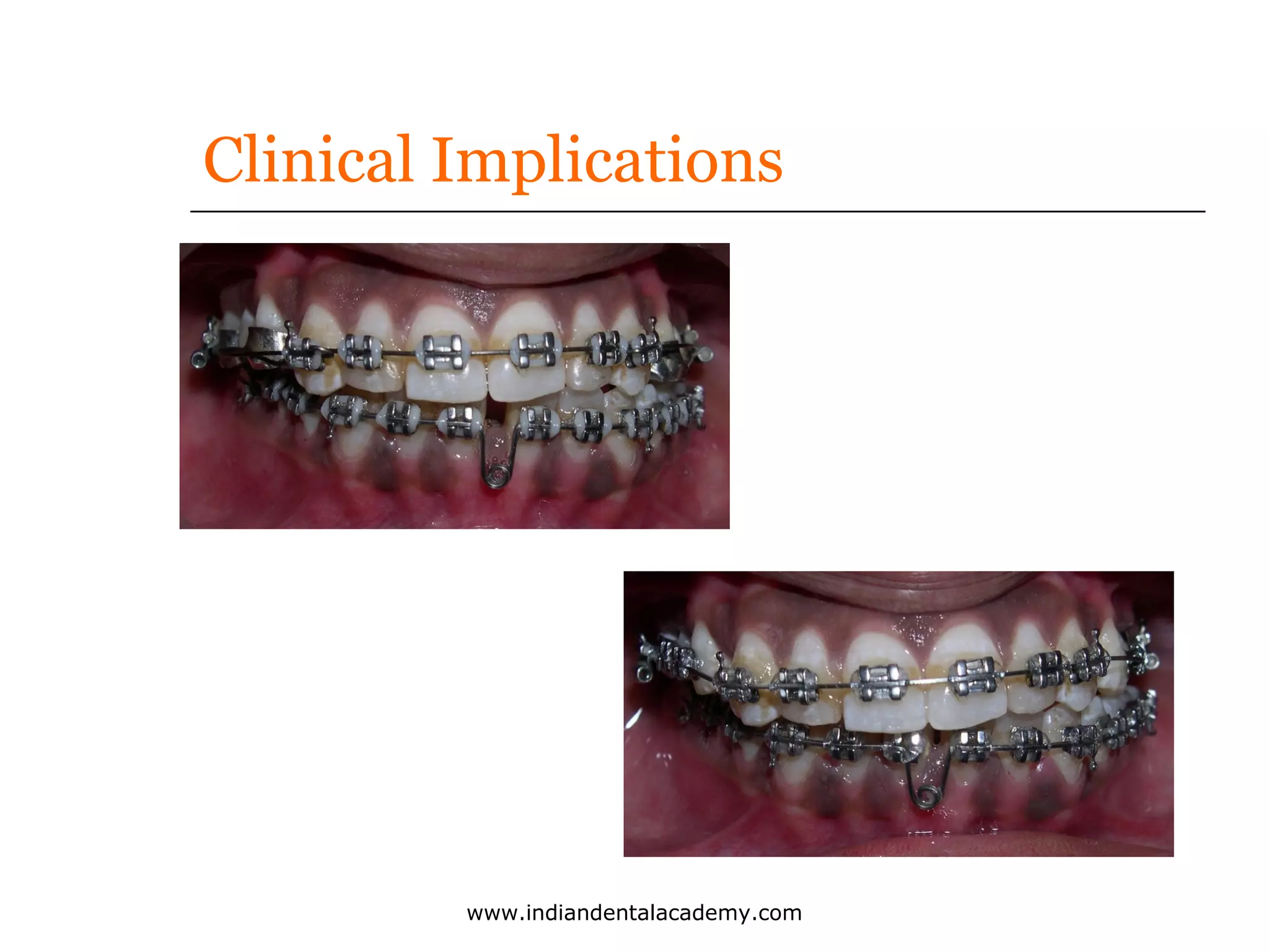 Clinical Implications

www.indiandentalacademy.com

 