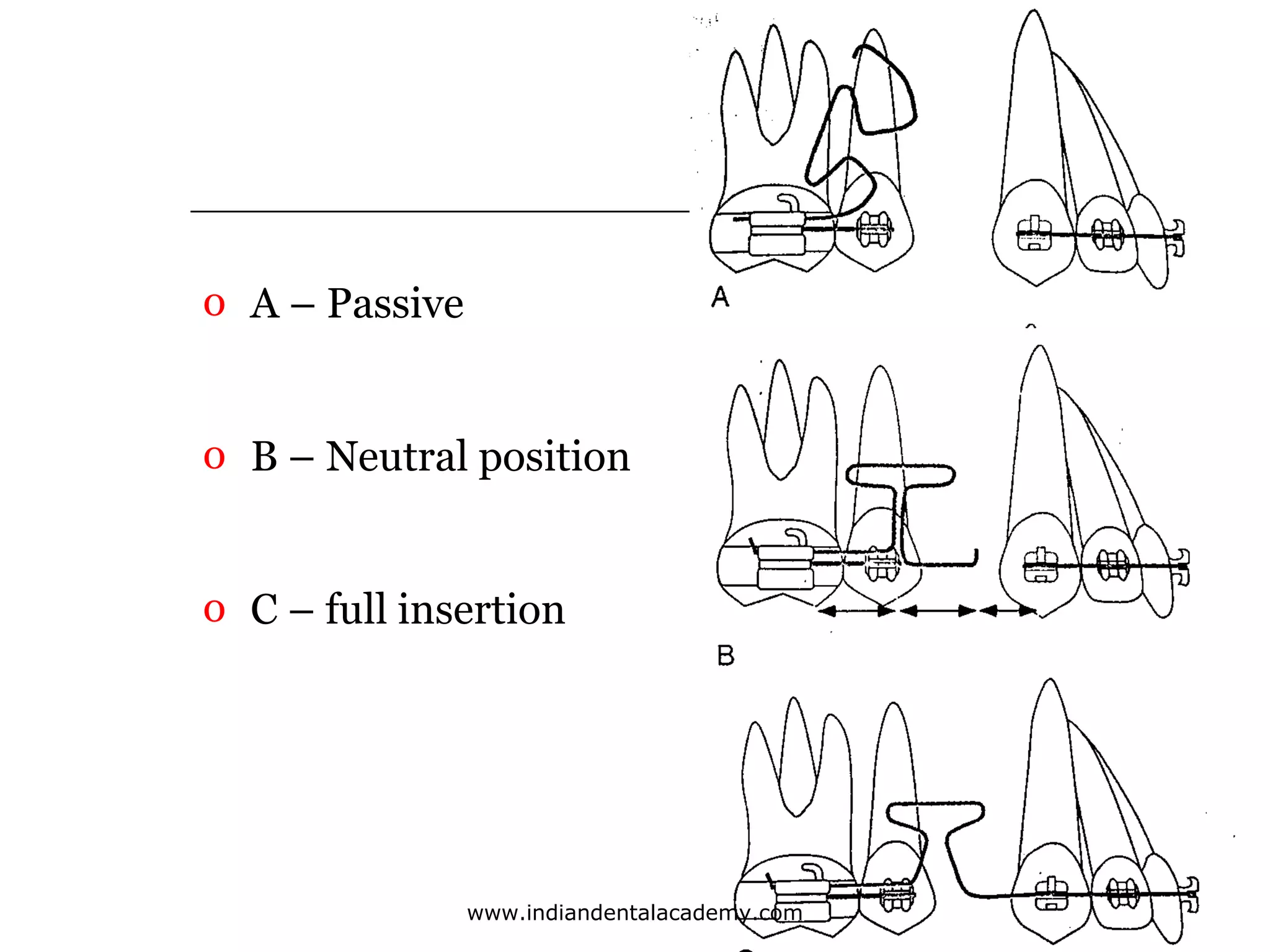 o A – Passive
o B – Neutral position
o C – full insertion

www.indiandentalacademy.com

 