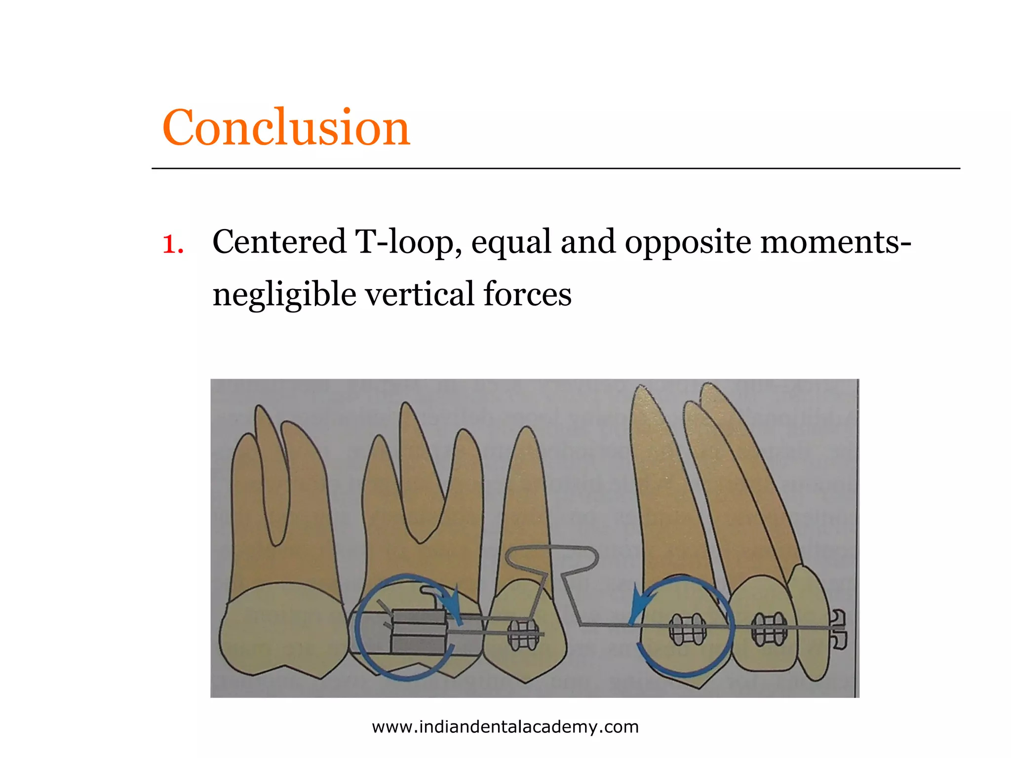Conclusion
1. Centered T-loop, equal and opposite momentsnegligible vertical forces

www.indiandentalacademy.com

 