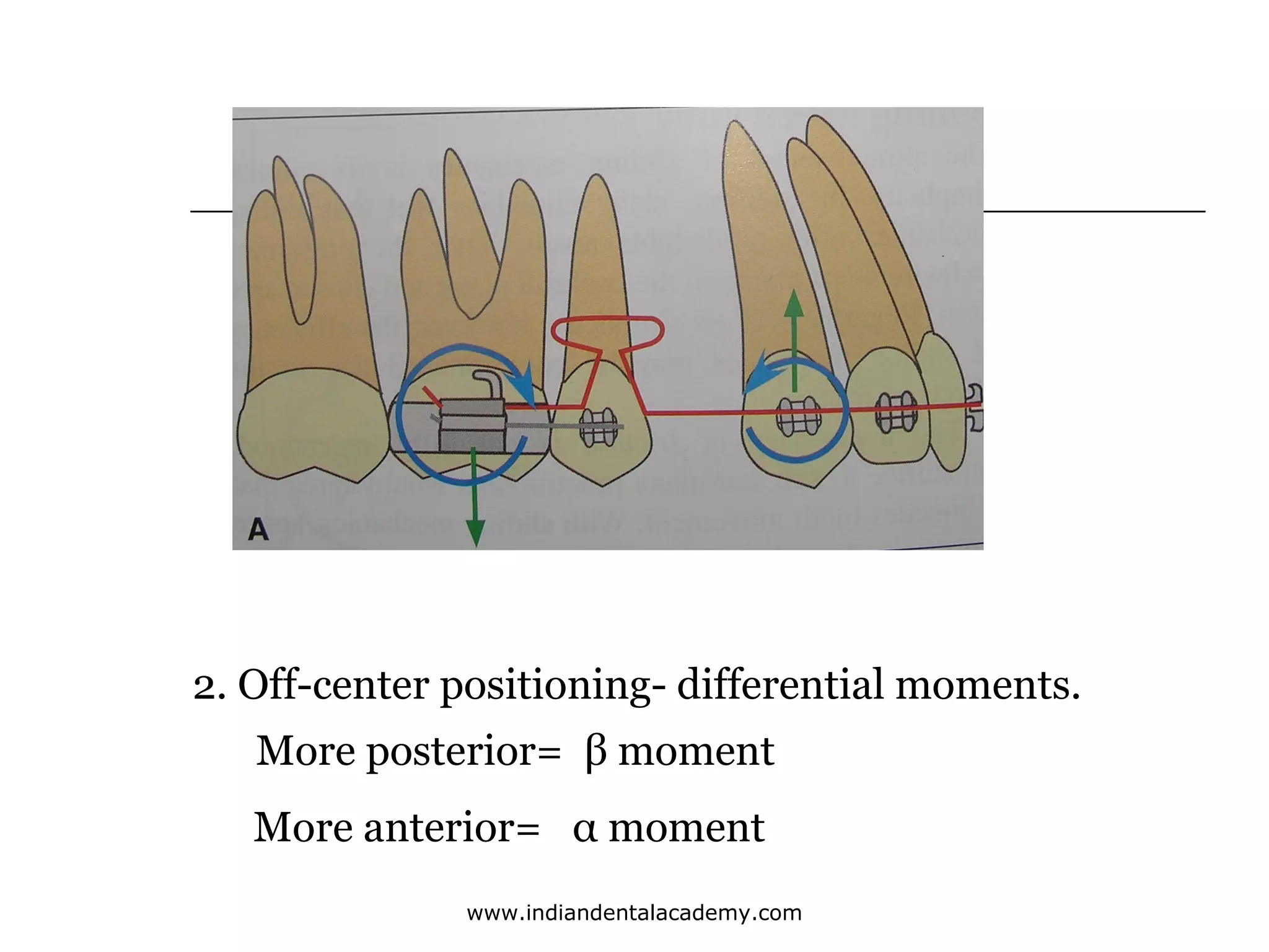 2. Off-center positioning- differential moments.
More posterior= β moment
More anterior= α moment
www.indiandentalacademy.com

 