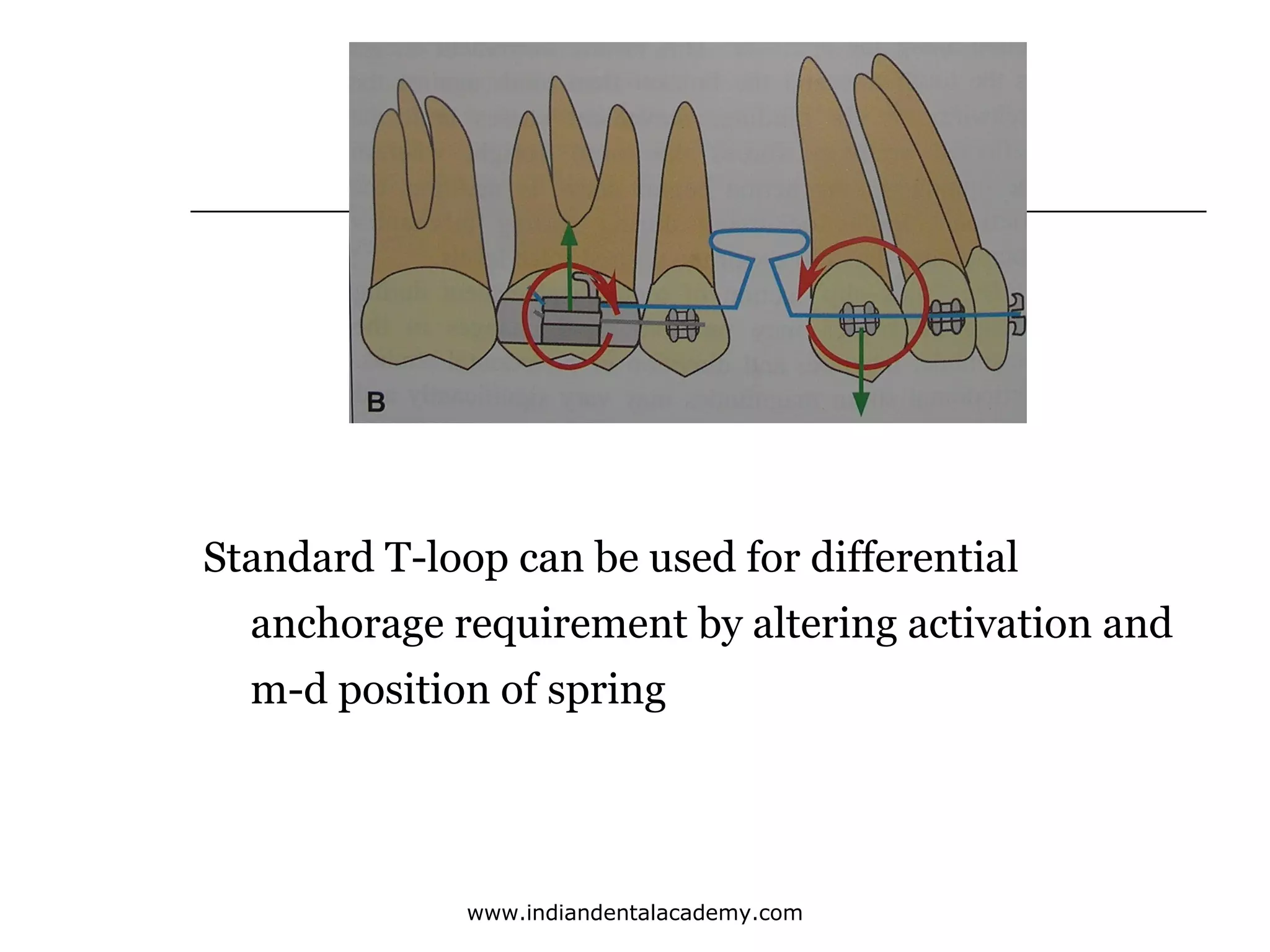 Standard T-loop can be used for differential
anchorage requirement by altering activation and
m-d position of spring

www.indiandentalacademy.com

 