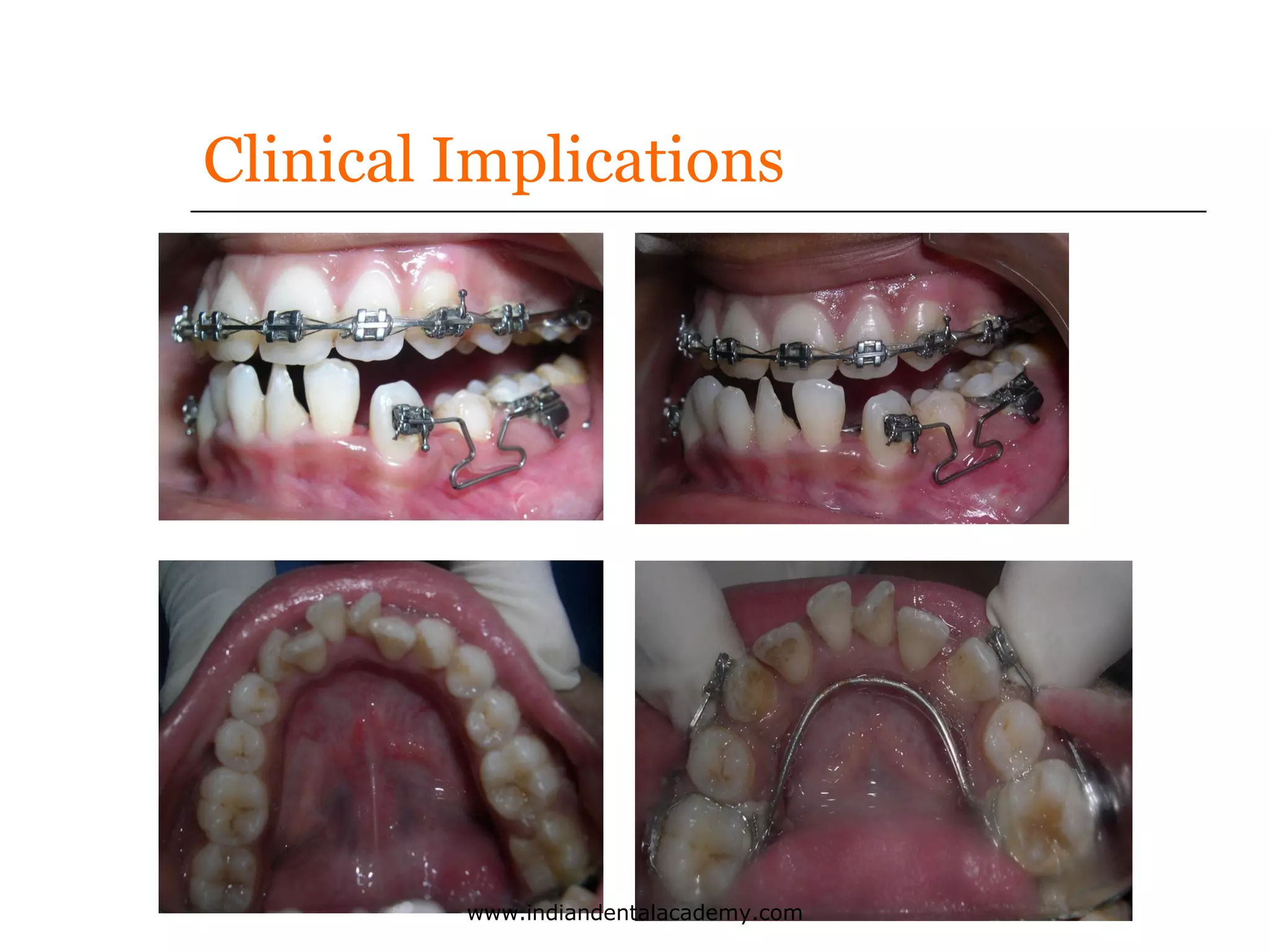 Clinical Implications

www.indiandentalacademy.com

 