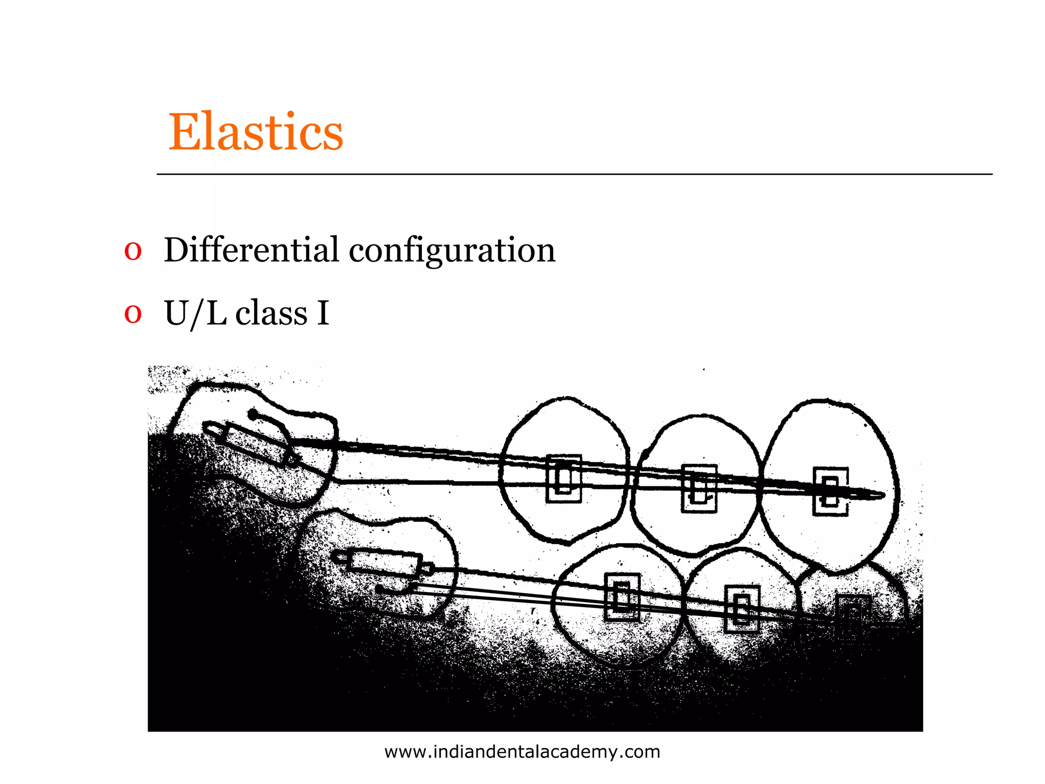 Elastics
o Differential configuration
o U/L class I

www.indiandentalacademy.com

 
