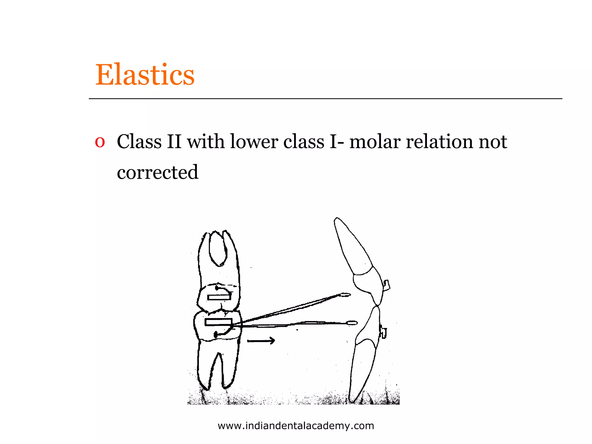 Elastics
o Class II with lower class I- molar relation not
corrected

www.indiandentalacademy.com

 