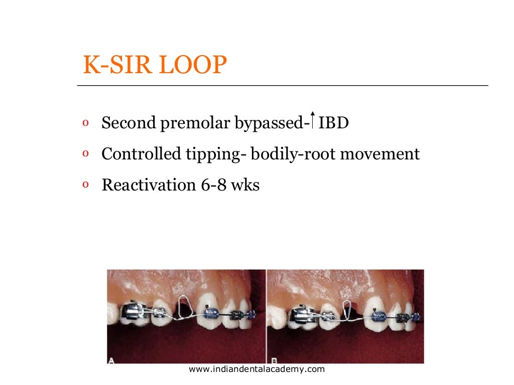 Bio mechanics of Space closure in orthodontics /certified fixed ortho…
