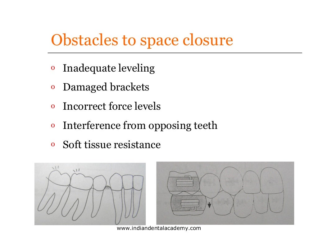 Bio mechanics of Space closure in orthodontics /certified fixed ortho…