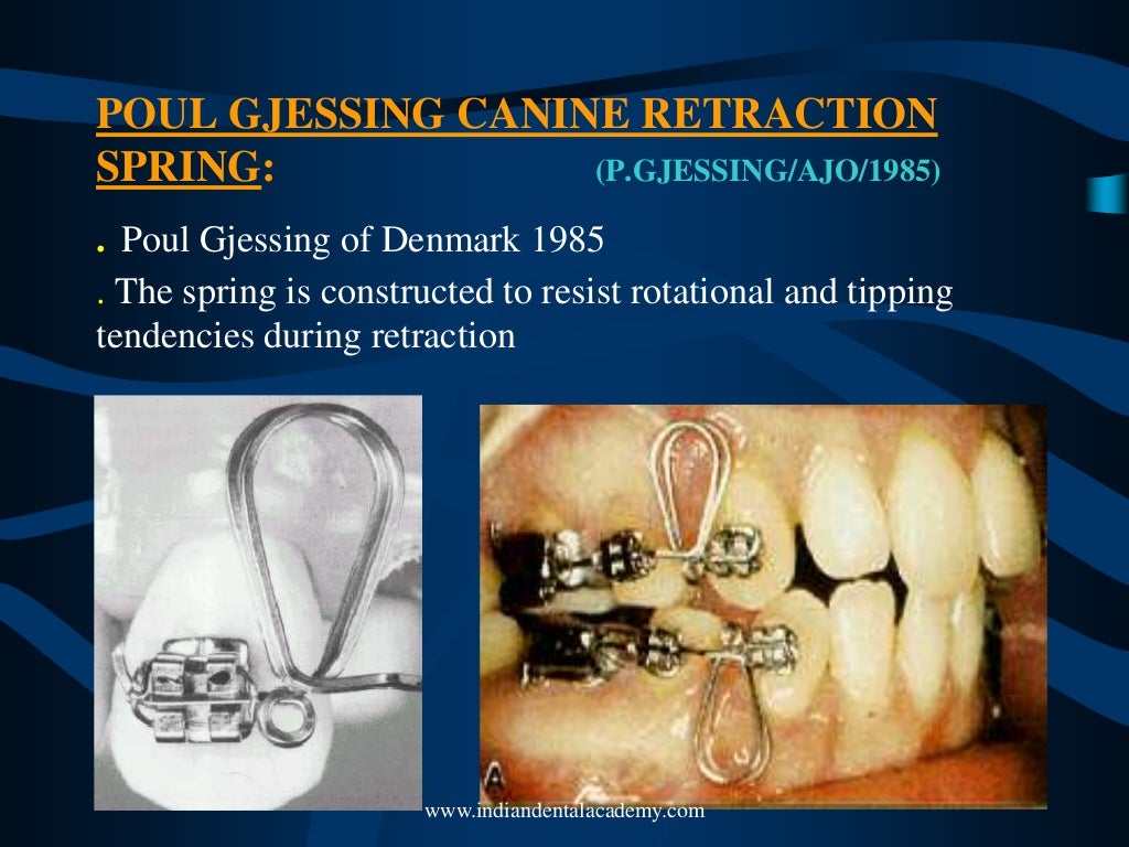 Space closure by frictionless mechanics 2 /certified fixed orthodonti…