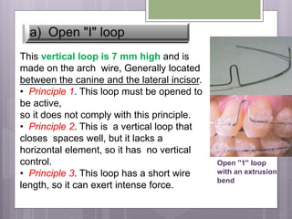This vertical loop is 7 mm high and is
made on the arch wire, Generally located
between the canine and the lateral incisor.
• Principle 1. This loop must be opened to
be active,
so it does not comply with this principle.
• Principle 2. This is a vertical loop that
closes spaces well, but it lacks a
horizontal element, so it has no vertical
control.
• Principle 3. This loop has a short wire
length, so it can exert intense force.
Open ''1'' loop
with an extrusion
bend
 