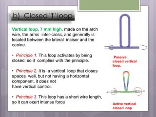Passive
closed vertical
loop.
Active vertical
closed loop
Vertical loop, 7 mm high, made on the arch
wire, the arms inter-cross, and generally is
located between the lateral incisor and the
canine.
• Principle 1. This loop activates by being
closed, so it complies with the principle.
• Principle 2. It is a vertical loop that closes
spaces well, but not having a horizontal
component, it does not
have vertical control.
• Principle 3. This loop has a short wire length,
so it can exert intense force
 