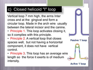 c) Closed helicoid "I" loop
Vertical loop 7 mm high, the arms Inter
cross and at the gingival end form a
circular loop. Made in the arch wire usually
between the lateral incisor and the canine.
• Principle 1. This loop activates closing it,
so it complies with this principle.
• Principle 2. A vertical loop that closes
spaces well, but not having a horizontal
component, it does not have vertical
control.
• Principle 3. This loop has an average wire
length so the force it exerts is of medium
intensity.
 