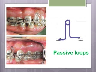 Passive loops
 