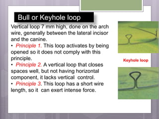 Bull or Keyhole loop
Vertical loop 7 mm high, done on the arch
wire, generally between the lateral incisor
and the canine.
• Principle 1. This loop activates by being
opened so it does not comply with this
principle.
• Principle 2. A vertical loop that closes
spaces well, but not having horizontal
component, it lacks vertical control.
• Principle 3. This loop has a short wire
length, so it can exert intense force.
Keyhole loop
 