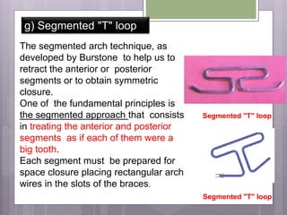 g) Segmented "T" loop
Segmented "T" loop
Segmented "T" loop
The segmented arch technique, as
developed by Burstone to help us to
retract the anterior or posterior
segments or to obtain symmetric
closure.
One of the fundamental principles is
the segmented approach that consists
in treating the anterior and posterior
segments as if each of them were a
big tooth.
Each segment must be prepared for
space closure placing rectangular arch
wires in the slots of the braces.
 