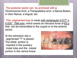 The posterior sector can be anchored with a
Chromosome Arch, a Transpalatine arch, a Nance Button,
a Viaro Nance, a lingual, etc.
This segmented loop is made with rectangular 0.017" x
0.025" TMA wire, which exerts an intrusive force of 63 g
that can be transmitted to the cuspid or to the anterior
sector.
At the extraction site a
segmented "T" is placed.
The distal portion is
inserted in the auxiliary
molar tube and the mesial
portion in the canine brace
 