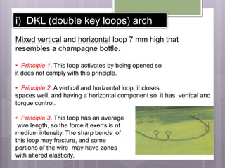 i) DKL (double key loops) arch
Mixed vertical and horizontal loop 7 mm high that
resembles a champagne bottle.
• Principle 1. This loop activates by being opened so
it does not comply with this principle.
• Principle 2. A vertical and horizontal loop, it closes
spaces well, and having a horizontal component so it has vertical and
torque control.
• Principle 3. This loop has an average
wire length, so the force it exerts is of
medium intensity. The sharp bends of
this loop may fracture, and some
portions of the wire may have zones
with altered elasticity.
 