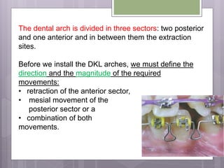 The dental arch is divided in three sectors: two posterior
and one anterior and in between them the extraction
sites.
Before we install the DKL arches, we must define the
direction and the magnitude of the required
movements:
• retraction of the anterior sector,
• mesial movement of the
posterior sector or a
• combination of both
movements.
 