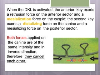 When the DKL is activated, the anterior key exerts
a retrusion force on the anterior sector and a
mesialization force on the cuspid; the second key
exerts a distalizing force on the canine and a
mesializing force on the posterior sector.
Both forces applied on
the canine are of the
same intensity and in
inverse direction,
therefore they cancel
each other.
 