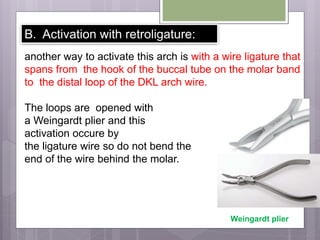 B. Activation with retroligature:
another way to activate this arch is with a wire ligature that
spans from the hook of the buccal tube on the molar band
to the distal loop of the DKL arch wire.
The loops are opened with
a Weingardt plier and this
activation occure by
the ligature wire so do not bend the
end of the wire behind the molar.
Weingardt plier
 