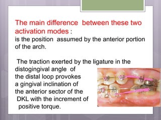 The main difference between these two
activation modes :
is the position assumed by the anterior portion
of the arch.
The traction exerted by the ligature in the
distogingival angle of
the distal loop provokes
a gingival inclination of
the anterior sector of the
DKL with the increment of
positive torque.
 