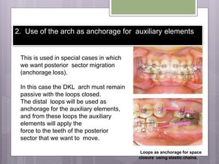 2. Use of the arch as anchorage for auxiliary elements
This is used in special cases in which
we want posterior sector migration
(anchorage loss).
In this case the DKL arch must remain
passive with the loops closed.
The distal loops will be used as
anchorage for the auxiliary elements,
and from these loops the auxiliary
elements will apply the
force to the teeth of the posterior
sector that we want to move.
Loops as anchorage for space
closure using elastic chains.
 