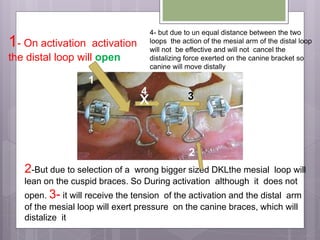 2-But due to selection of a wrong bigger sized DKLthe mesial loop will
lean on the cuspid braces. So During activation although it does not
open. 3- it will receive the tension of the activation and the distal arm
of the mesial loop will exert pressure on the canine braces, which will
distalize it
1- On activation activation
the distal loop will open
x
1
2
34
4- but due to un equal distance between the two
loops the action of the mesial arm of the distal loop
will not be effective and will not cancel the
distalizing force exerted on the canine bracket so
canine will move distally
 
