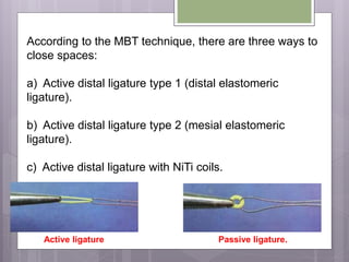 According to the MBT technique, there are three ways to
close spaces:
a) Active distal ligature type 1 (distal elastomeric
ligature).
b) Active distal ligature type 2 (mesial elastomeric
ligature).
c) Active distal ligature with NiTi coils.
Passive ligature.Active ligature
 