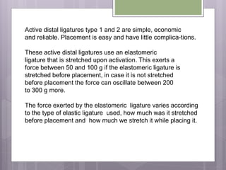 Active distal ligatures type 1 and 2 are simple, economic
and reliable. Placement is easy and have little complica-tions.
These active distal ligatures use an elastomeric
ligature that is stretched upon activation. This exerts a
force between 50 and 100 g if the elastomeric ligature is
stretched before placement, in case it is not stretched
before placement the force can oscillate between 200
to 300 g more.
The force exerted by the elastomeric ligature varies according
to the type of elastic ligature used, how much was it stretched
before placement and how much we stretch it while placing it.
 