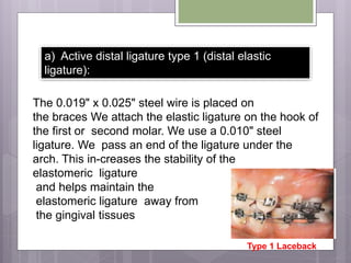a) Active distal ligature type 1 (distal elastic
ligature):
The 0.019" x 0.025" steel wire is placed on
the braces We attach the elastic ligature on the hook of
the first or second molar. We use a 0.010" steel
ligature. We pass an end of the ligature under the
arch. This in-creases the stability of the
elastomeric ligature
and helps maintain the
elastomeric ligature away from
the gingival tissues
Type 1 Laceback
 