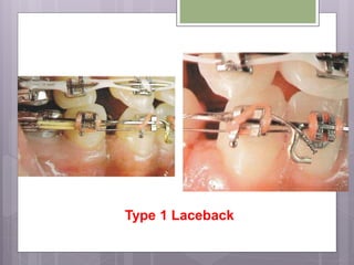 Type 1 Laceback
 