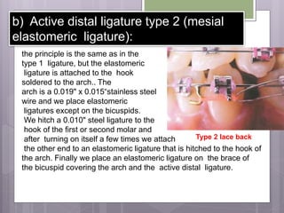 b) Active distal ligature type 2 (mesial
elastomeric ligature):
the principle is the same as in the
type 1 ligature, but the elastomeric
ligature is attached to the hook
soldered to the arch.. The
arch is a 0.019" x 0.015“stainless steel
wire and we place elastomeric
ligatures except on the bicuspids.
We hitch a 0.010" steel ligature to the
hook of the first or second molar and
after turning on itself a few times we attach
the other end to an elastomeric ligature that is hitched to the hook of
the arch. Finally we place an elastomeric ligature on the brace of
the bicuspid covering the arch and the active distal ligature.
Type 2 lace back
 