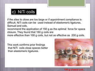 c) NiTi coils
if the sites to close are too large or if appointment compliance is
difficult, NiTi coils can be used instead of elastomeric ligatures,
Samuel and cols.
recommend the application of 150 g as the optimal force for space
closure, They found that 150 g coils are
more effective than 100 g coils, but not as effective as 200 g coils.
This work confirms prior findings
that NiTi coils close spaces better
than elastomeric ligatures.
150 g closed coil.
 
