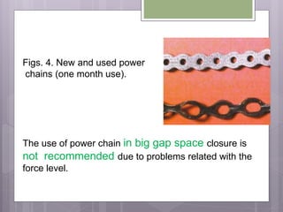 Figs. 4. New and used power
chains (one month use).
The use of power chain in big gap space closure is
not recommended due to problems related with the
force level.
 
