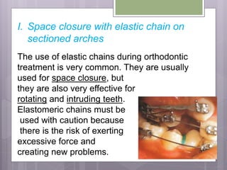 I. Space closure with elastic chain on
sectioned arches
The use of elastic chains during orthodontic
treatment is very common. They are usually
used for space closure, but
they are also very effective for
rotating and intruding teeth.
Elastomeric chains must be
used with caution because
there is the risk of exerting
excessive force and
creating new problems.
 