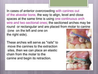 In cases of anterior overcrowding with canines out
of the alveolar bone, the way to align, level and close
spaces at the same time is using one continuous arch
wire and two sectional ones; the sectioned arches may be
round or rectangular and are placed from molar to canine
(one on the left and one on
the right side).
These arches will serve as "rails" to
move the canines to the extraction
sites, then we can place an elastic
chain from the molar to the
canine and begin its retraction.
 