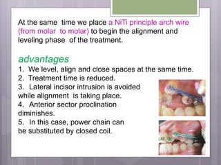 At the same time we place a NiTi principle arch wire
(from molar to molar) to begin the alignment and
leveling phase of the treatment.
advantages
1. We level, align and close spaces at the same time.
2. Treatment time is reduced.
3. Lateral incisor intrusion is avoided
while alignment is taking place.
4. Anterior sector proclination
diminishes.
5. In this case, power chain can
be substituted by closed coil.
 