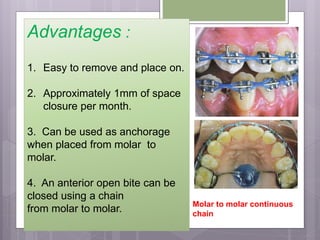 Advantages :
1. Easy to remove and place on.
2. Approximately 1mm of space
closure per month.
3. Can be used as anchorage
when placed from molar to
molar.
4. An anterior open bite can be
closed using a chain
from molar to molar. Molar to molar continuous
chain
 