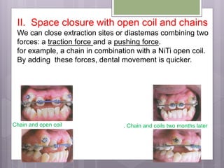 II. Space closure with open coil and chains
We can close extraction sites or diastemas combining two
forces: a traction force and a pushing force.
for example, a chain in combination with a NiTi open coil.
By adding these forces, dental movement is quicker.
Chain and open coil . Chain and coils two months later
 