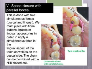 This is done with two
simultaneous forces
(buccal and lingual). We
must place additional
buttons, braces or
lingual accessories in
order to apply a
simultaneous force in
the
lingual aspect of the
tooth as well as on the
buccal side. The chain
can be combined with a
NiTi closed coil.
Canine retraction
with parallel chains.
Two weeks after
V. Space closure with
parallel forces
 