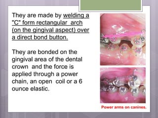 They are made by welding a
"C" form rectangular arch
(on the gingival aspect) over
a direct bond button.
They are bonded on the
gingival area of the dental
crown and the force is
applied through a power
chain, an open coil or a 6
ounce elastic.
Power arms on canines.
 