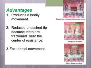 Advantages
1. Produces a bodily
movement.
2. Reduced undesired tip
because teeth are
tractioned near the
center of resistance.
3.Fast dental movement.
Diastema closure with power arms
After two months.
After three months.
 