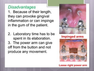 Disadvantages
1. Because of their length,
they can provoke gingival
inflammation or can impinge
in the gum of the patient.
2. Laboratory time has to be
spent in its elaboration.
3. The power arm can give
off from the button and not
produce any movement.
Impinged arms
Loose right power arm
 