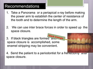 1. Take a Panorama or a periapical x-ray before making
the power arm to establish the center of resistance of
the tooth and to determine the length of the arm.
2. We can use inter brace forces in order to speed up the
space closure.
3. If black triangles are formed after
space closure is accomplished, some
enamel stripping may be convenient.
4. Send the patient to a periodontist for a frenectomy after
space closure.
Recommendations
 