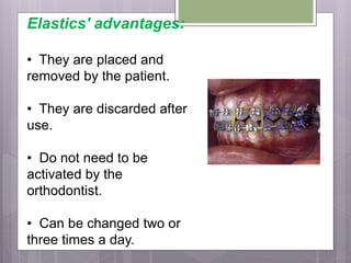 Elastics' advantages:
• They are placed and
removed by the patient.
• They are discarded after
use.
• Do not need to be
activated by the
orthodontist.
• Can be changed two or
three times a day.
 